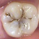 충치치료에 금이 과연 최고의 치과재료일까? 이미지