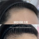 [후기] 인천 학익동 MO100 모백 두피생장술로 헤어라인 잔머리 채우기! 탈모고민 이제 그만