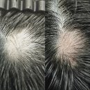 그로우모모 두피 탈모 케어센터 | 울산 탈모 관리 삼산동 그로우모모 두피탈모케어센터 모발생장술 MO100앰플 3회차 전/후 비교