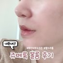 첨단밝은얼굴피부과의원 | 부산 피부과 추천 쥬베룩볼륨 팔자주름 내돈내산 후기