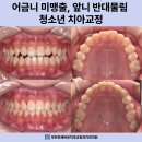디자인치과기공소 | 부천상동치과 어금니가 안 나와요. 어금니 미맹출, 앞니 반대 물림 청소년 치아교정
