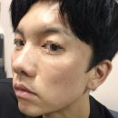 하늘체한의원 | &lt;하늘체한의원 인천&gt; 재방문, 지우개필 시술 후기