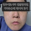 원레이져 | [주근깨, 기미레이저] 전주 피부과 엔블랑의원 레이저 후기(1~3회차)