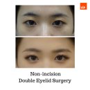 브이아이피성형외과의원 | [eyes] 쌍꺼풀 수술: 제주 VIP 성형외과 피부과