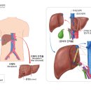 간암치료방법과 식생활 가이드 이미지