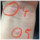 수지한의원 | 방아쇠수지 증후군 한의원 통증 치료 후기