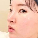 제야 | 부평코필러 실리프팅 가격 후기 제야의 고수 찾아감.. (내돈내산)