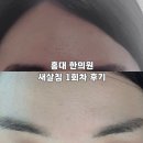 안진약품 | [홍대] 오래된 흉터, 여드름 흉터, 내돈내산 새살침 일주일 후기