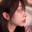 절골 | 매부리코수술후기, 무서운 절골 없이도 충분히 교정 가능해요! (+비용)