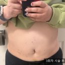 몸의형태 | [복부지방분해주사 3차 후기] 숫자보다 먼저 느껴지는 변화, 몸의 ‘라인’이 달라지다