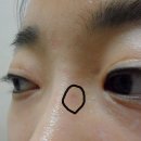수두자국 흉터치료 사진올려요~~ 헤헤(사진 有) 이미지