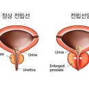 ◈남자들 만성 전립성 왜생기나◈ 이미지