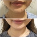 브이씨씨주 | 더미인 클리닉 후기(30초의 기적/티슬림/여드름치료/색소치료)