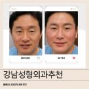 페이스성형외과의원 | 강남성형외과추천 풀페이스지방이식 받은 후기