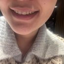 [강남 라미네이트] 강남 레브치과 윗니 4개 자연스러운 라미네이트 후기- 내가 원하던 치아 완성