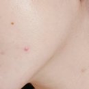 잠실새내역(6번출구뒤) | [잠실 여드름 피부관리샵]폴라리스 에스테틱! 압출, 스피큘, 리프팅