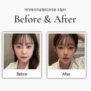 귀필러, 중안부 축소와 얼굴 비율 보완이 된다고?
