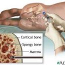 골수 검사[bone marrow examination] 질환이란? 이미지