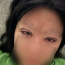 세란플러스성형외과의원 | 하니성형외과 내돈내산 후기 :: 쌍커풀수술 쌍커풀 재수술 뒷트임 후기