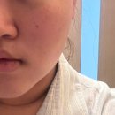 폴라리스 | 강남역피부과전문의 꼼꼼 상담, 울쎄라대신 더블로폴라리스레이저 솔직후기/1주일 효과