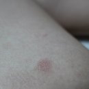 참길한의원 | 아빠크림 후기ㅣ아토피,건선 ㅣ 내돈내산