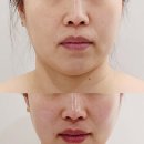 아벨라 에스테틱 | 대전 피부관리 에스테틱 탄방동 아벨라뷰티 맞춤 윤곽관리 신부관리 온업리프팅 후기