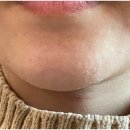 홍대여드름한의원 3회차 피부 변화 후기