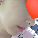 얼굴 편평사마귀 제거 co2레이저 후기(세달후사진)
