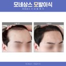자가모발이식술, 어떻게 해야 생착률 높을까?