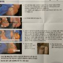 메디본 | 메디커넥트 내성발톱 교정기 사서 해본 후기 (발톱 사진 있음)