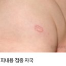 원메디컬 | 남양주 다산 [위드미메디컬의원] 1차영유아검진 &amp; BCG 피내용 접종 후기 / 경피용 차이점