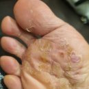 동래우리한의원 | 부산동래피부과? 스테로이드에 의존해도 가려움에 시달리는 분들의 공통점 1가지