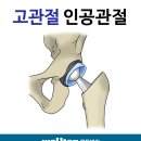 인공 고관절 치환술//고관절 통증//고관절 수술 잘하는 병원// 이미지