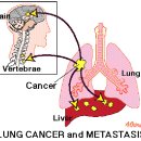 폐암증상,폐암자가진단,폐암초기증상,폐암말기 모든걸 파헤치다 . 이미지