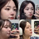 오두보건진료소 | 여자 자려한 코성형 내돈내산 붓기 후기 당일부터 일주일 2달 경과 후기 사진, 비용까지