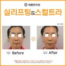 서울예쁨의원 네이버블로그