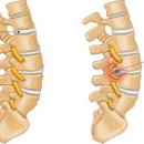 허리가 너무 아파요 허리가 찌릿 아플때 이유 이미지