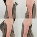 짐팔팔 평택본점 | 평택피부관리 피오렌에스테틱 티리온 팔뚝관리로 절반 팔뚝 만들다