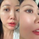 피오티 | 청량리피부과 스컬피오 리프팅레이저 후기 안아픈리프팅 추천 솔직후기