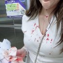 아무러스성형외과의원 | 대구얼굴봉합 얼굴찢어짐 상처봉합 주말 응급병원 아무러스성형외과 수술후기