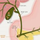 담석증 및 통증 원인 검사 제거 쓸개 담석 담낭결석 이미지