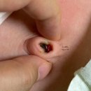 배꼽 | 신생아 배꼽 육아종 제거 후기