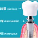참좋은부부치과의원 | 가평치과, 의사들이 임플란트 브랜드 안 따지는 이유?