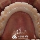 [ 구미 이튼연합 치과 ] 잇몸 재현을 할 수 있는 &#39;풀아치&#39; 제작 과정 및 실제 환자분의 후기