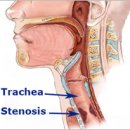 기도협착 tracheal stenoisis 이미지