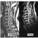 척수증 이미지