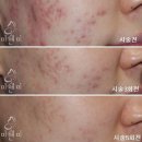 봄에 예민해지는 피부 여드름!! 여드름 치료하기^^* 기미 제거하기~~!