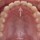 삼송우리들치과의원 | 삼송역 치과 불규칙한 치열 악궁 확장 장치를 이용한 치아 교정 과정