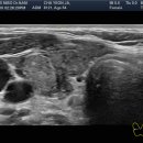 갑상선초음파-갑상샘 미세유두암(Papillary thyroid microcarcinoma ,PTMC) 이미지