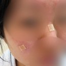 동그라미약국 | [후기] 공장형 피부과에서 편평사마귀 제거, 점제거, 보톡스 맞은 후기